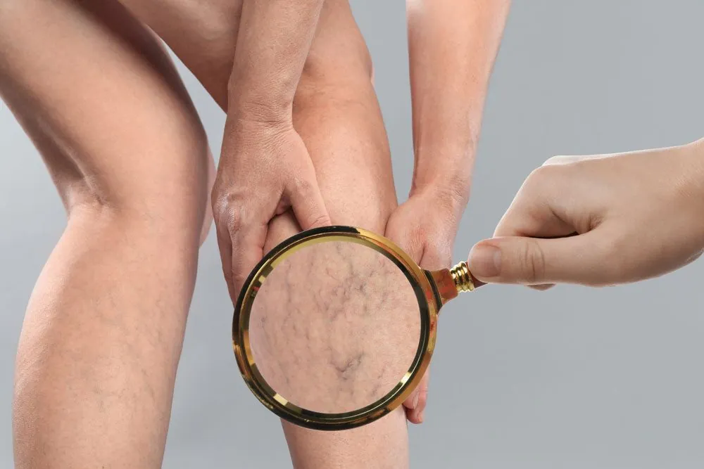 Varicose Veins: More Than Skin Deep