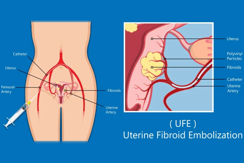 Uterine Fibroid Embolization
